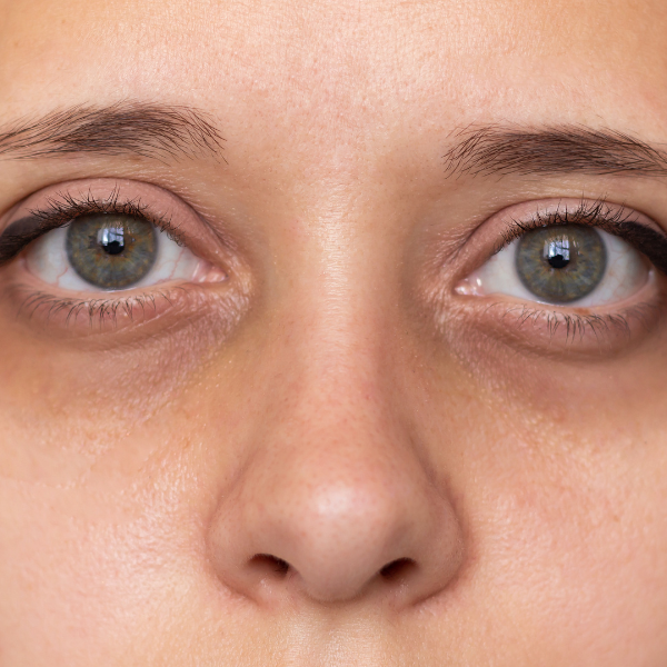 Under-eye skin showing fine lines and reduced skin quality