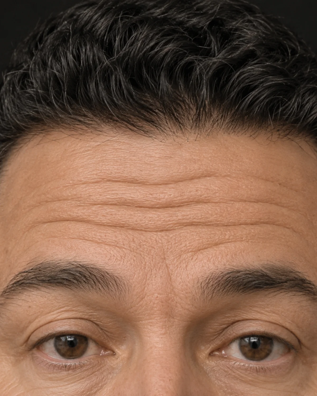 Close-up of forehead showing horizontal lines and upper-face heaviness