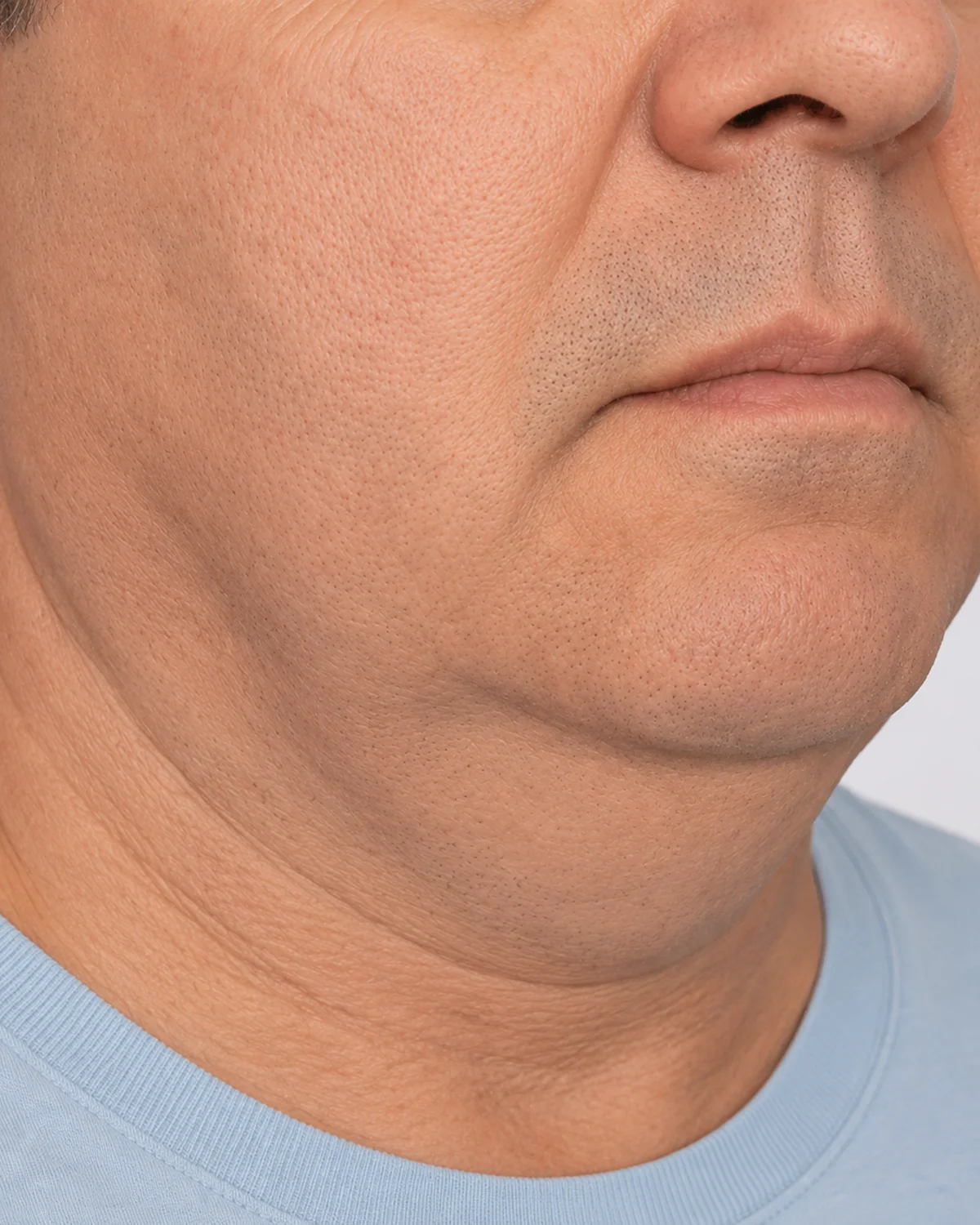 Three-quarter view showing reduced firmness beneath the chin